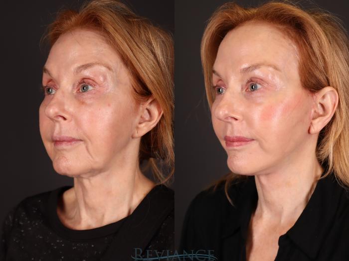 Before & After Facelift Case 2232 1/4 View in Portland, OR