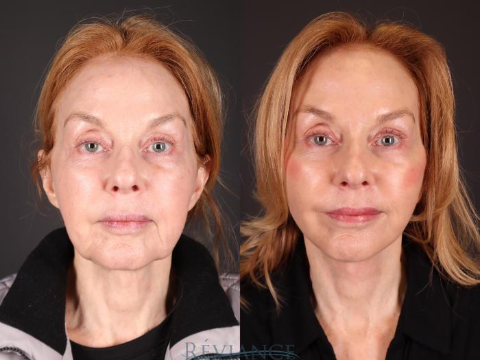 Before & After Facelift Case 2232 Front View in Portland, OR