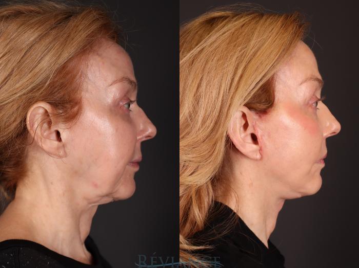 Before & After Facelift Case 2232 Right Side View in Portland, OR