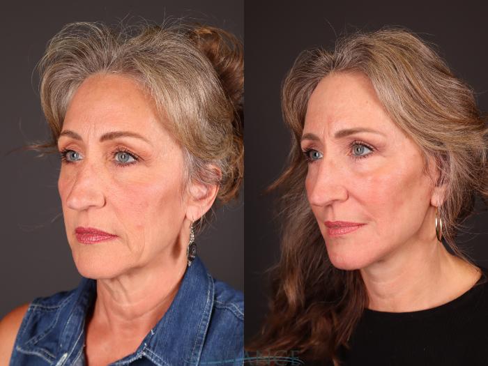 Before & After Facelift Case 2234 1/4 View in Portland, OR