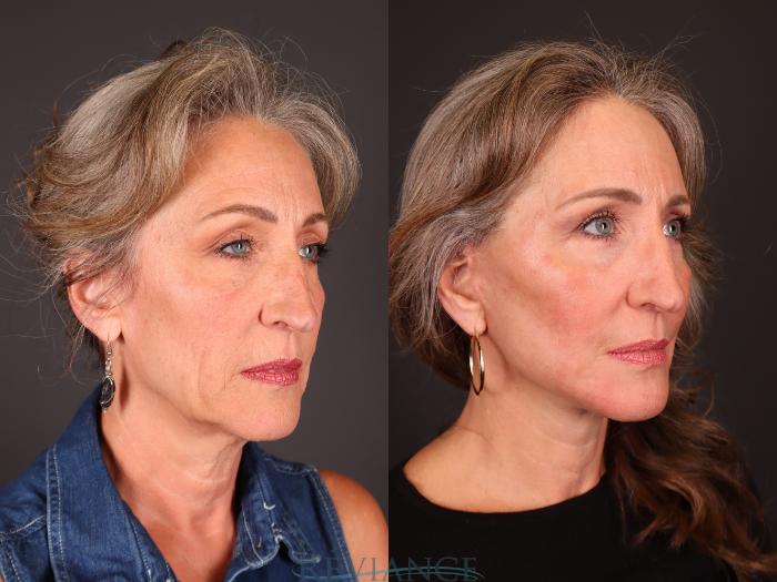 Before & After Facelift Case 2234 3/4 View in Portland, OR