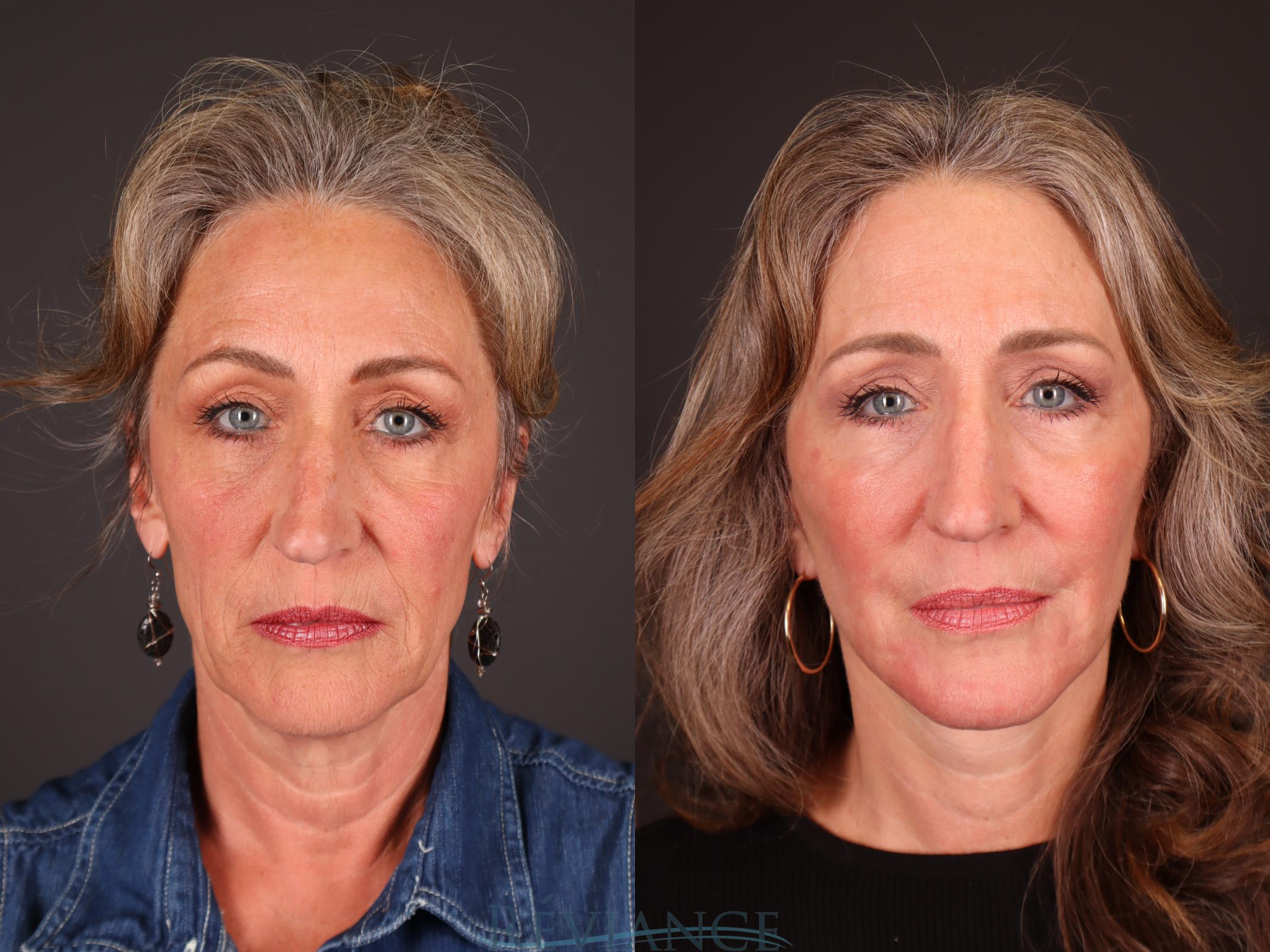 Before & After Facelift Case 2234 Front View in Portland, OR