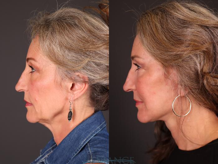 Before & After Facelift Case 2234 Left Side View in Portland, OR