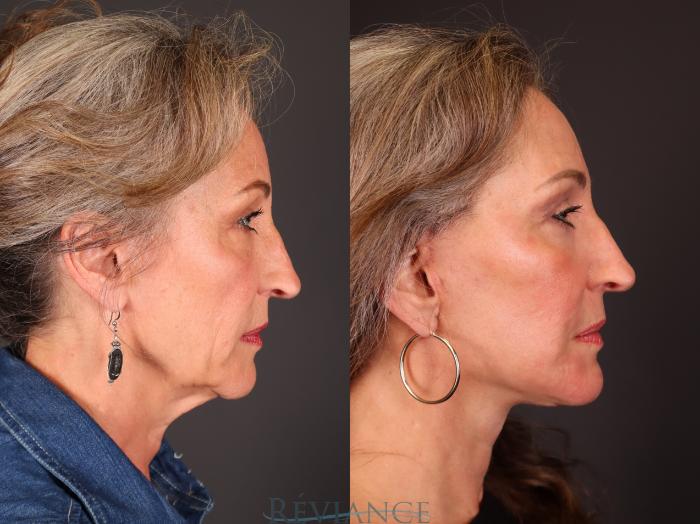 Before & After Facelift Case 2234 Right Side View in Portland, OR