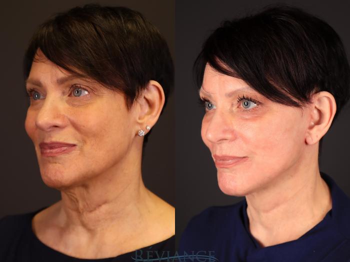 Before & After Facelift Case 2236 1/4 View in Portland, OR