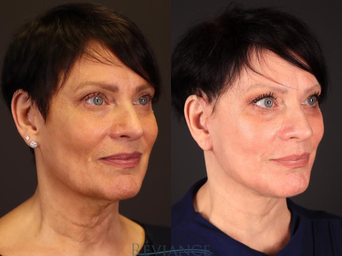 Before & After Facelift Case 2236 3/4 View in Portland, OR