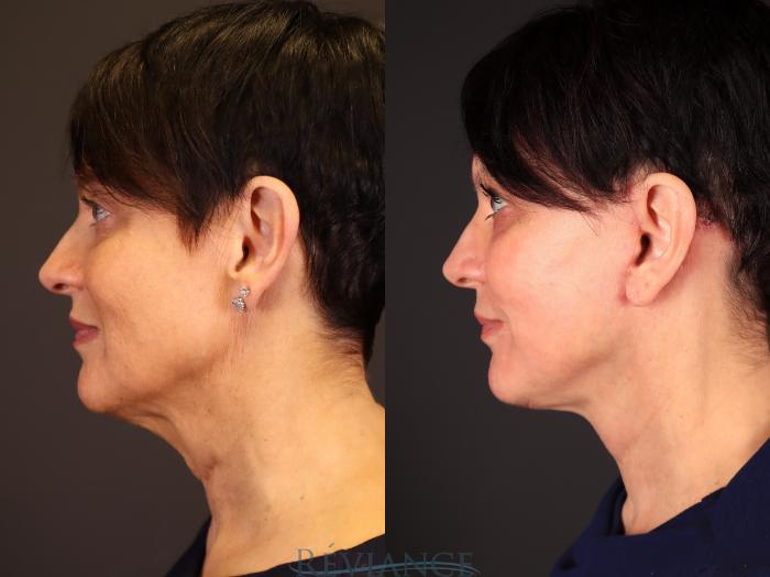 Before & After Facelift Case 2236 Left Side View in Portland, OR