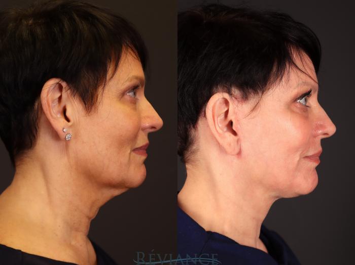 Before & After Facelift Case 2236 Right Side View in Portland, OR