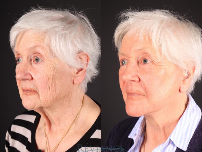 Before & After Facelift Case 2242 1/4 View in Portland, OR
