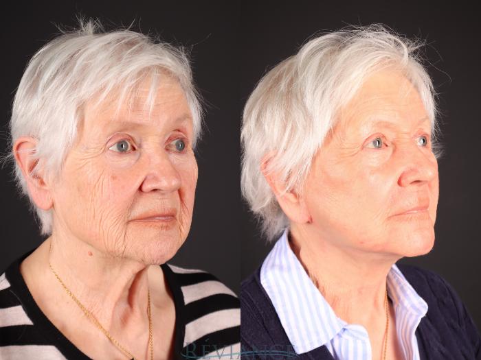 Before & After Facelift Case 2242 3/4 View in Portland, OR