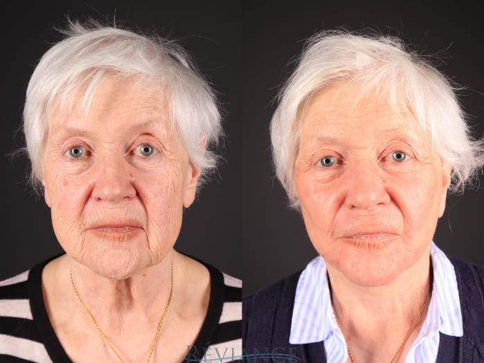 Before & After Facelift Case 2242 Front View in Portland, OR