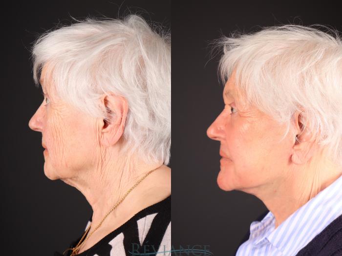 Before & After Facelift Case 2242 Left Side View in Portland, OR