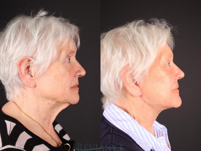 Before & After Facelift Case 2242 Right Side View in Portland, OR
