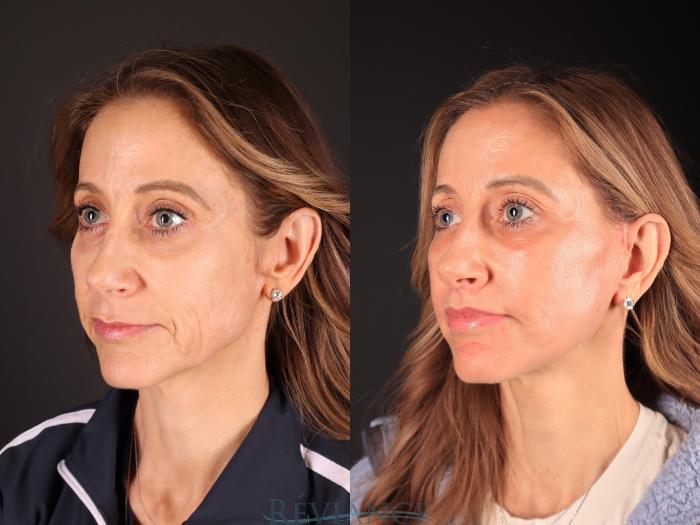 Before & After Facelift Case 2243 1/4 View in Portland, OR
