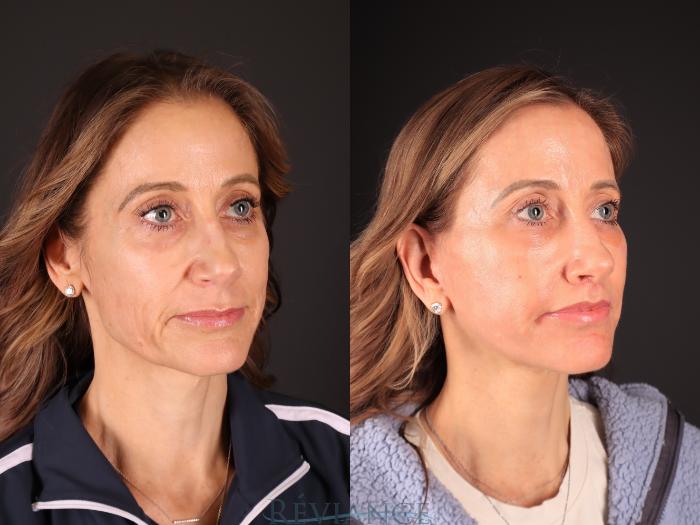 Before & After Facelift Case 2243 3/4 View in Portland, OR