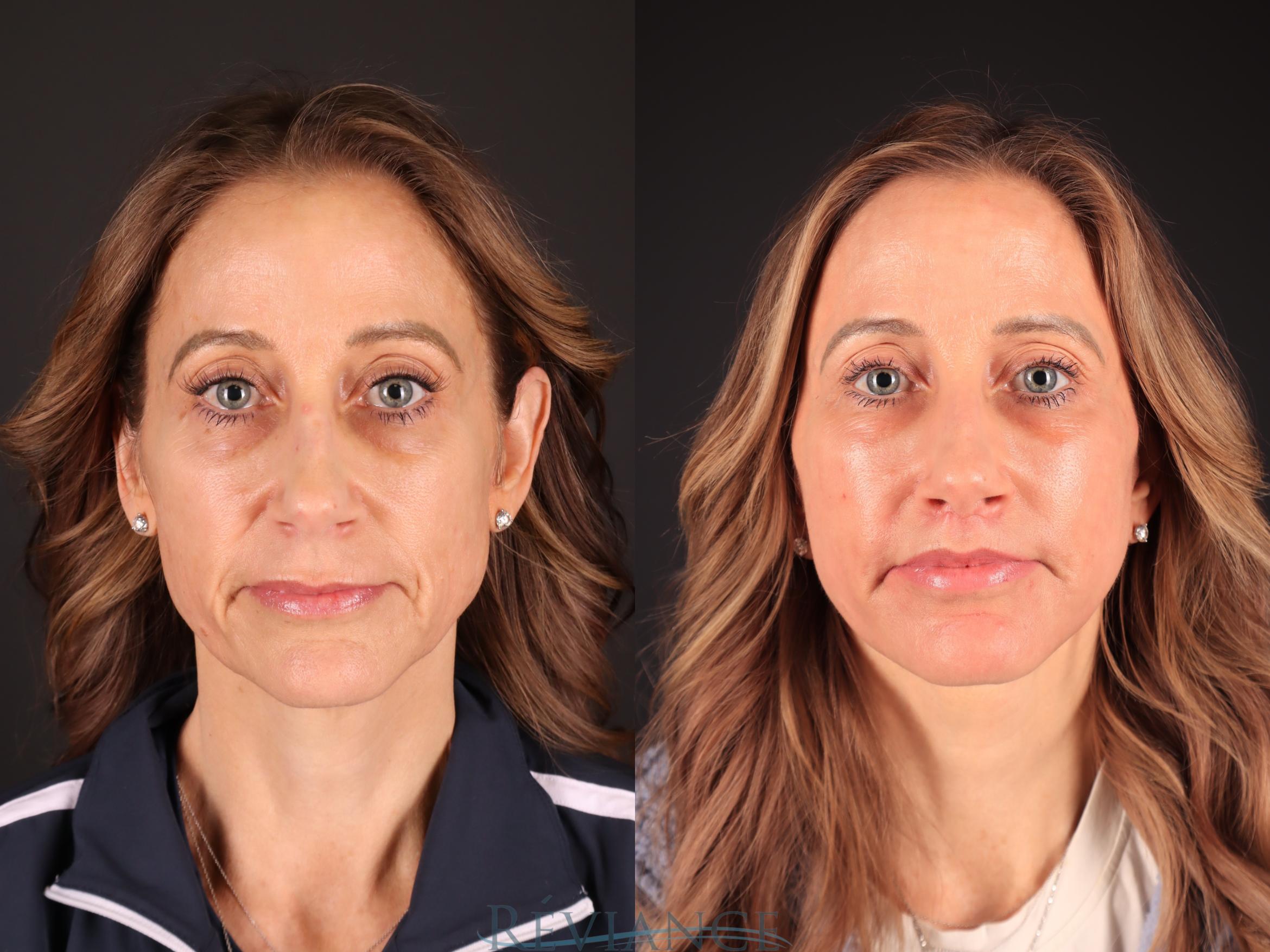 Before & After Facelift Case 2243 Front View in Portland, OR