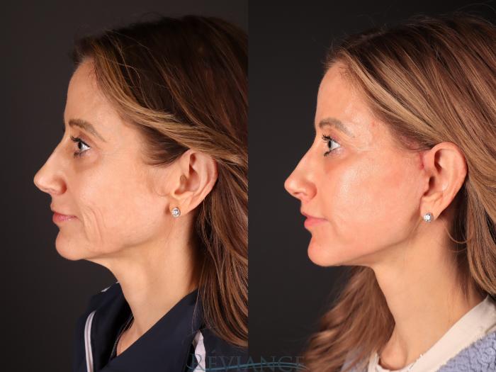 Before & After Facelift Case 2243 Left Side View in Portland, OR