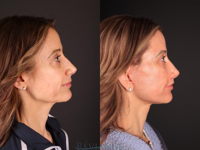 Before & After Facelift Case 2243 Right Side View in Portland, OR