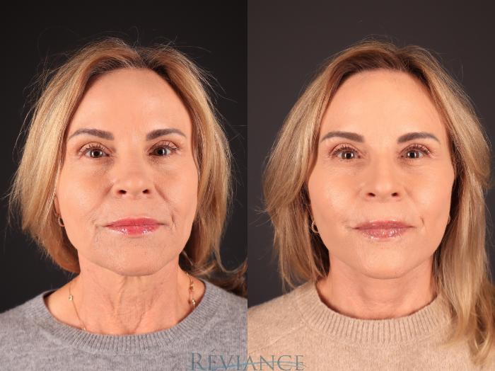 Before & After Facelift Case 2250 Front View in Portland, OR