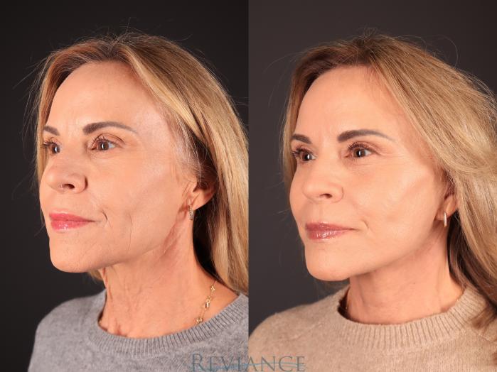 Before & After Facelift Case 2250 Left Oblique View in Portland, OR