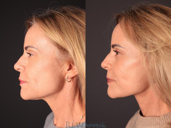 Before & After Facelift Case 2250 Left Side View in Portland, OR