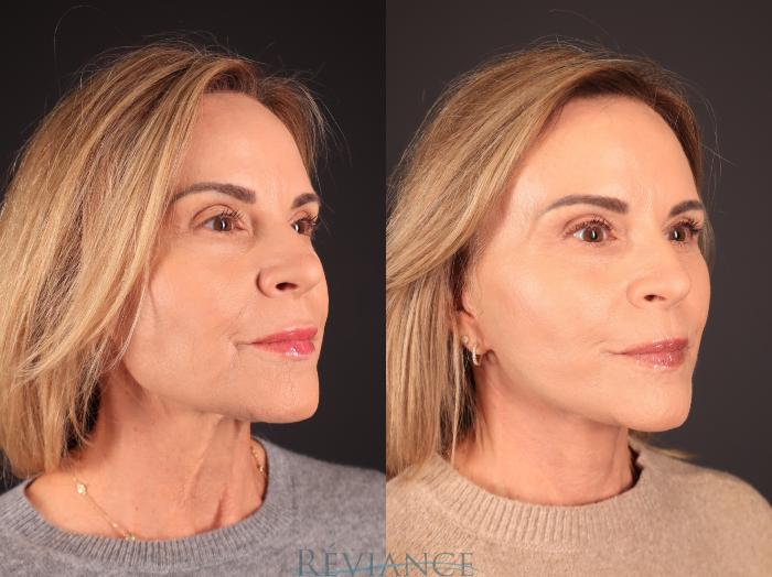 Before & After Facelift Case 2250 Right Oblique View in Portland, OR