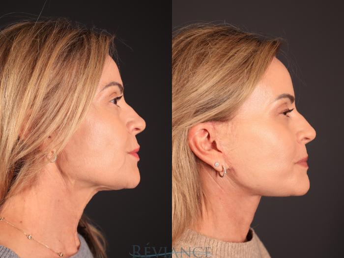 Before & After Facelift Case 2250 Right Side View in Portland, OR