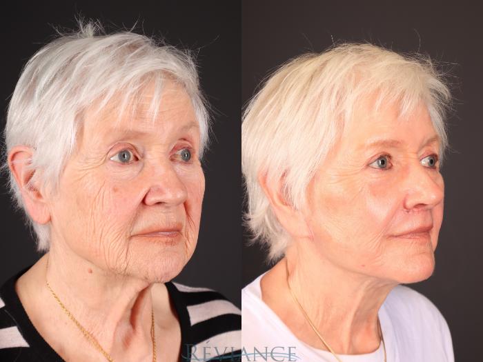 Before & After Facelift Case 2251 Left Oblique View in Portland, OR