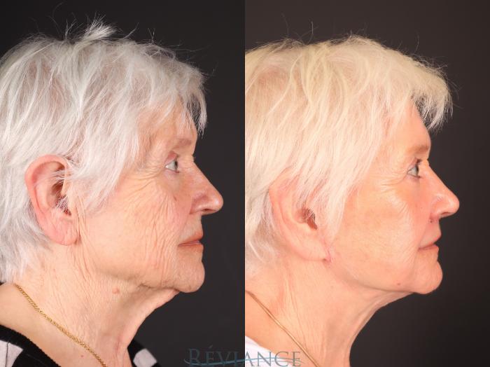 Before & After Facelift Case 2251 Left Side View in Portland, OR