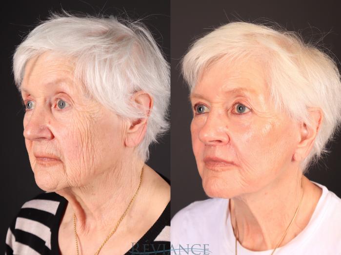 Before & After Facelift Case 2251 Right Oblique View in Portland, OR