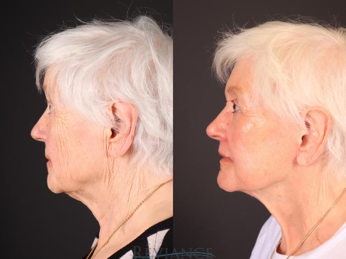 Before & After Facelift Case 2251 Right Side View in Portland, OR