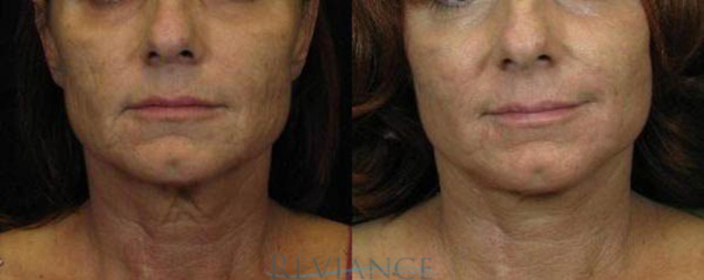 Before & After Neck Lift Case 79 View #1 View in Portland, OR