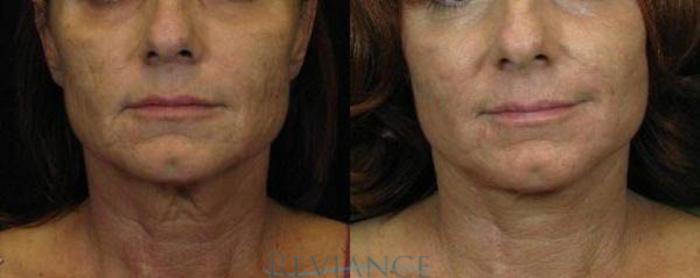 Before & After Neck Lift Case 79 View #1 View in Portland, OR
