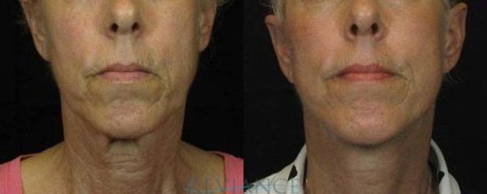 Before & After Neck Lift Case 89 View #1 View in Portland, OR