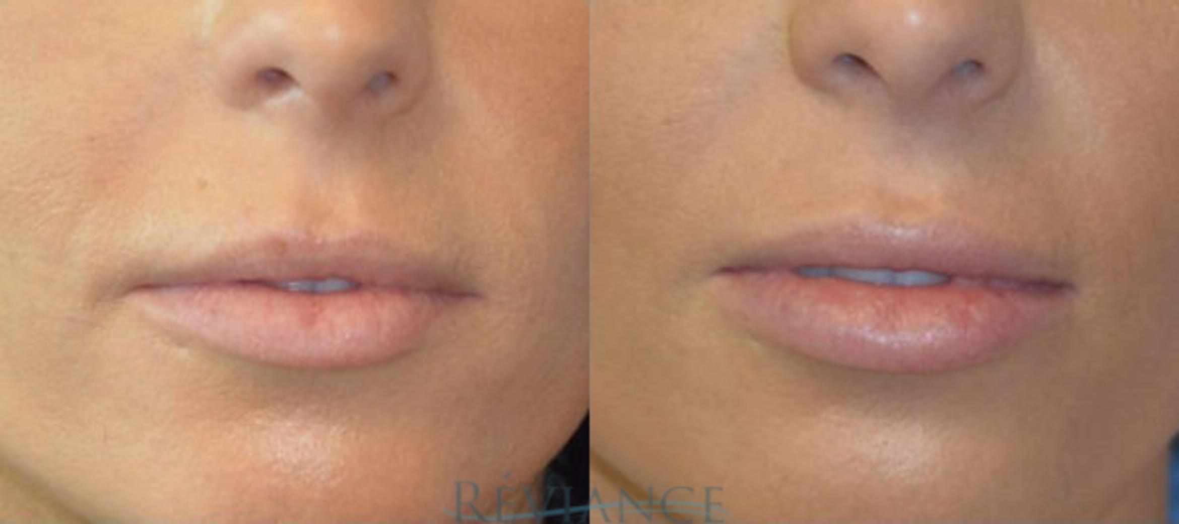 Before & After Lip Augmentation Case 1405 View #1 View in Portland, OR