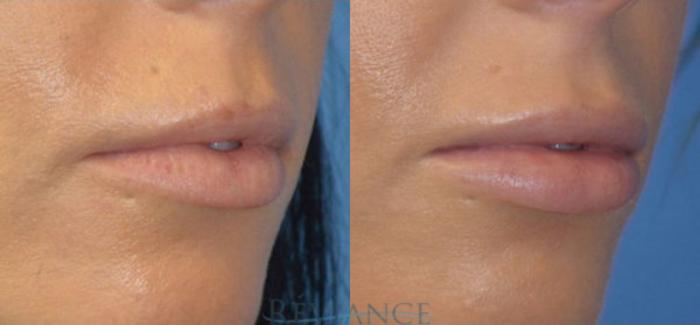 Before & After Lip Augmentation Case 1405 View #2 View in Portland, OR