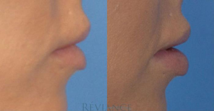 Before & After Lip Augmentation Case 1405 View #3 View in Portland, OR