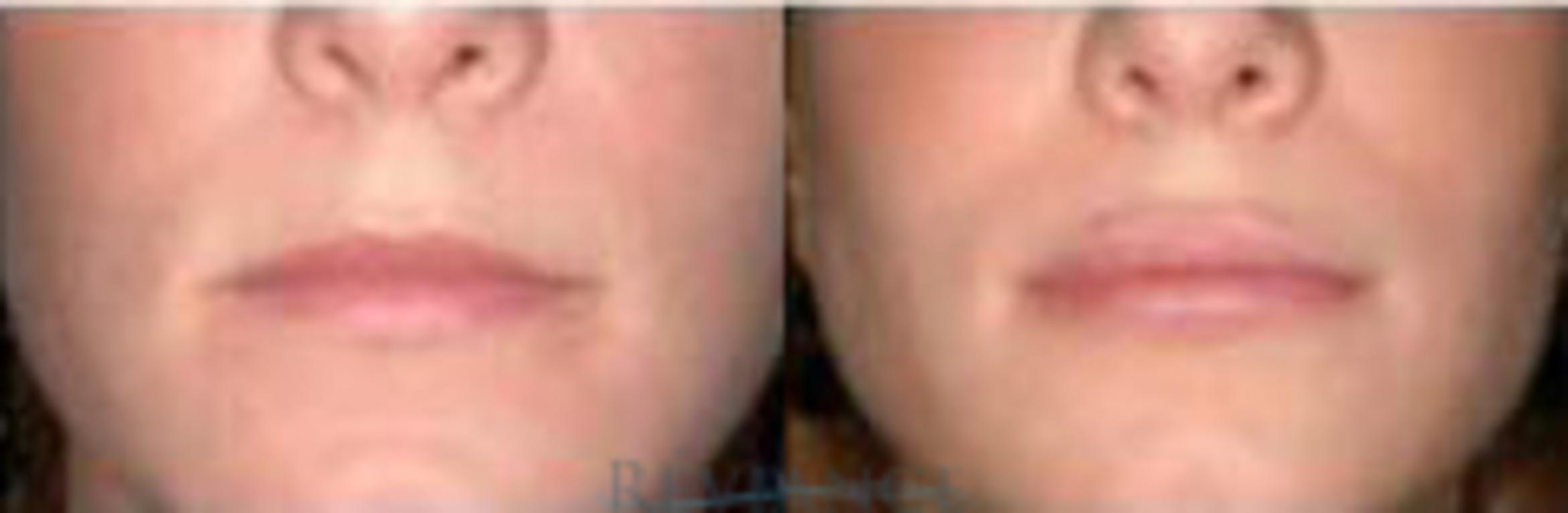Before & After Lip Augmentation Implant Case 177 View #1 View in Portland, OR