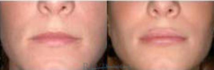 Before & After Lip Augmentation Implant Case 177 View #1 View in Portland, OR