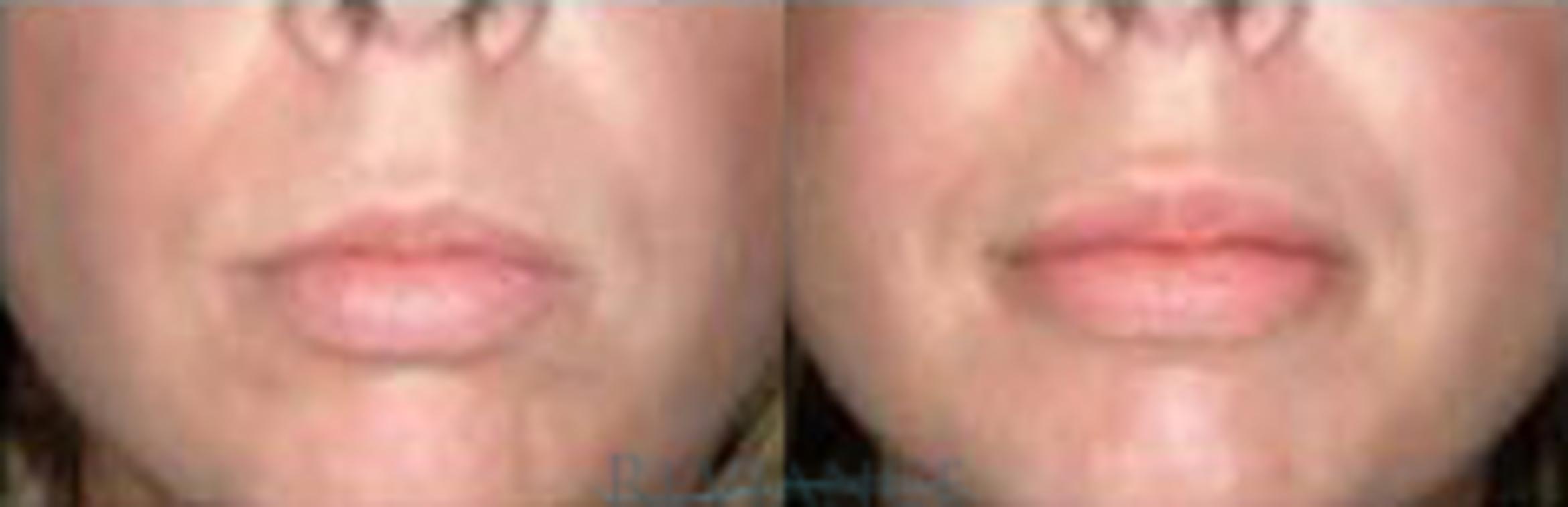 Before & After Lip Augmentation Implant Case 183 View #1 View in Portland, OR