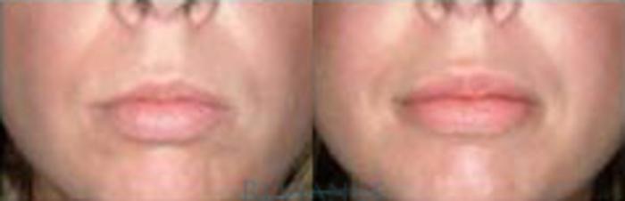 Before & After Lip Augmentation Implant Case 183 View #1 View in Portland, OR