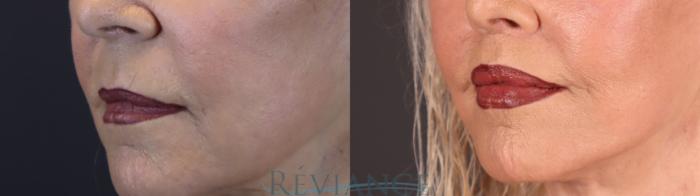 Before & After Lip Lift Case 2237 1/4 View in Portland, OR