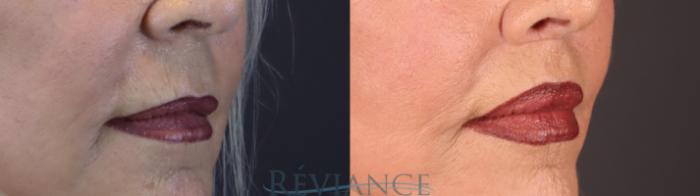 Before & After Lip Lift Case 2237 3/4 View in Portland, OR