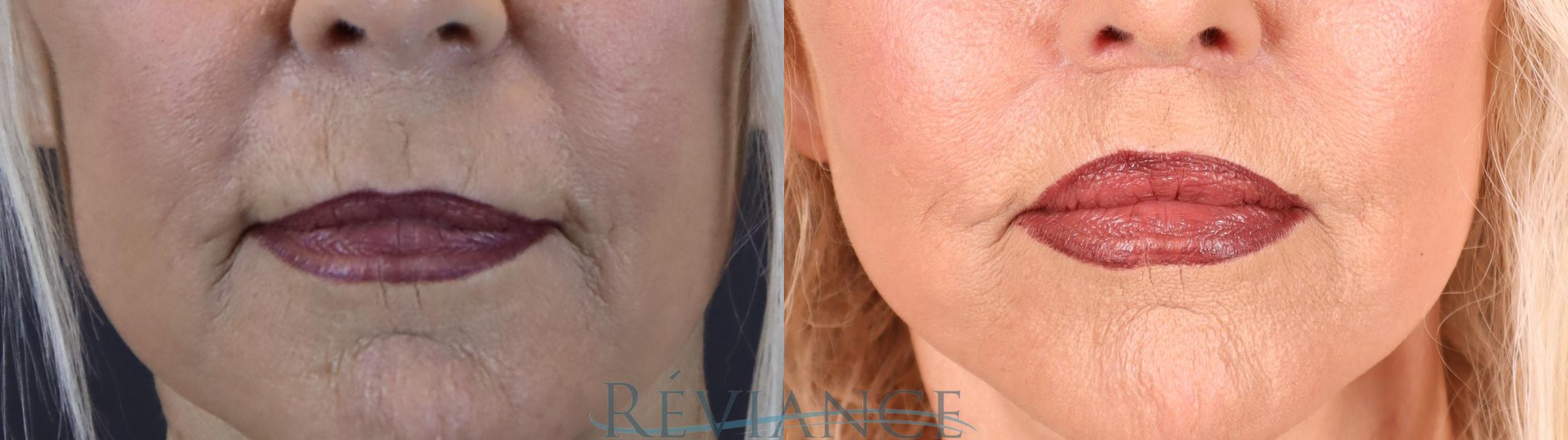 Before & After Lip Lift Case 2237 Front View in Portland, OR