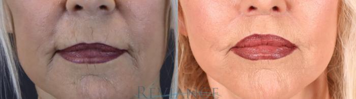 Before & After Lip Lift Case 2237 Front View in Portland, OR