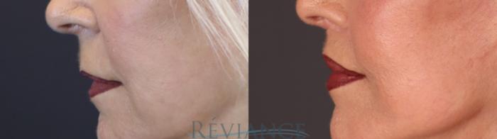 Before & After Lip Lift Case 2237 Left Side View in Portland, OR