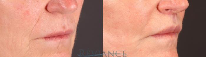 Before & After Lip Lift Case 2238 1/4 View in Portland, OR