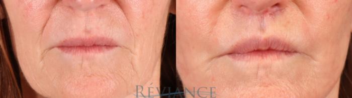 Before & After Lip Lift Case 2238 Front View in Portland, OR