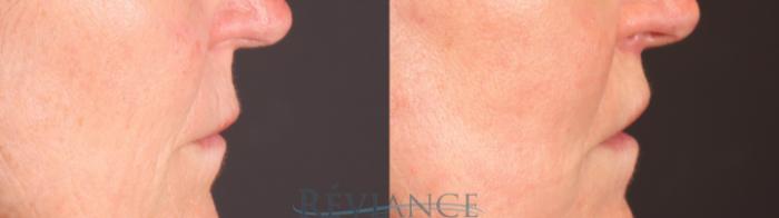 Before & After Lip Lift Case 2238 Right Side View in Portland, OR