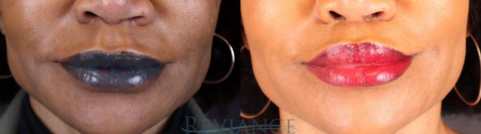 Before & After Lip Lift Case 2239 Front View in Portland, OR